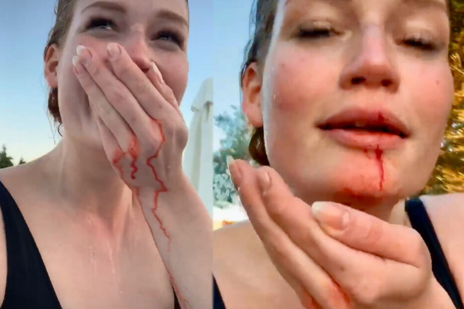 Heftig! So verletzt zeigt sich Heinisch ihren Fans in ihrer Instagram-Story – und trotzdem vergeht ihr das Lachen nicht.