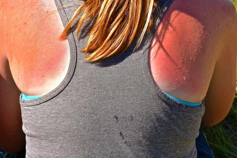Wer so rot ist, hat es mit dem Sonnenbaden eindeutig übertrieben.