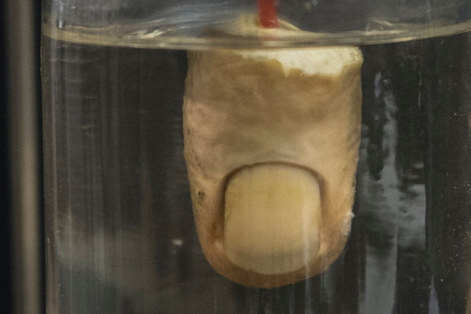 Der Finger konnte nicht mehr angenäht werden. (Symbolbild)