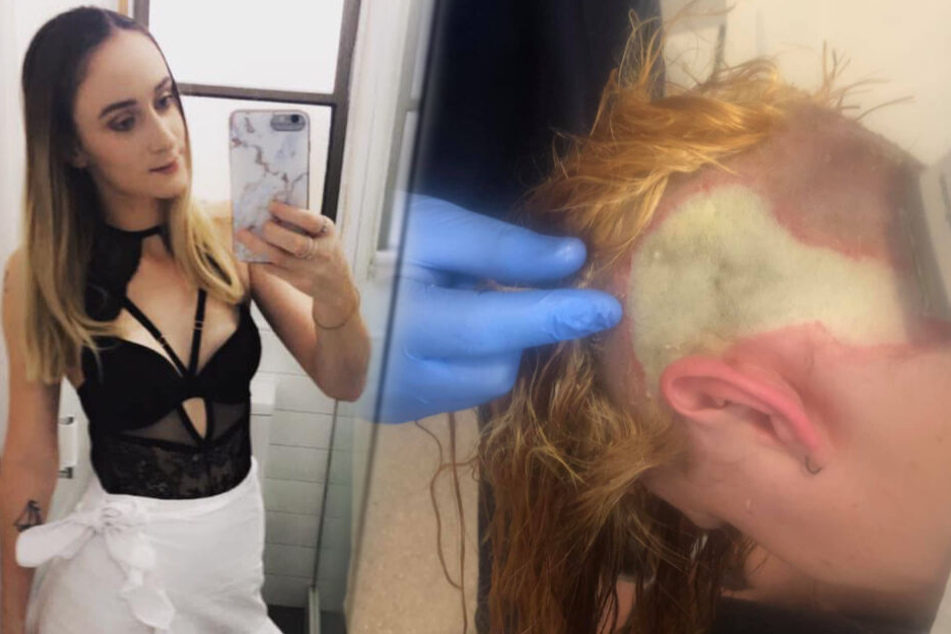 Frau bleicht Haare selbst: Jetzt drohen ihr Hauttransplantationen