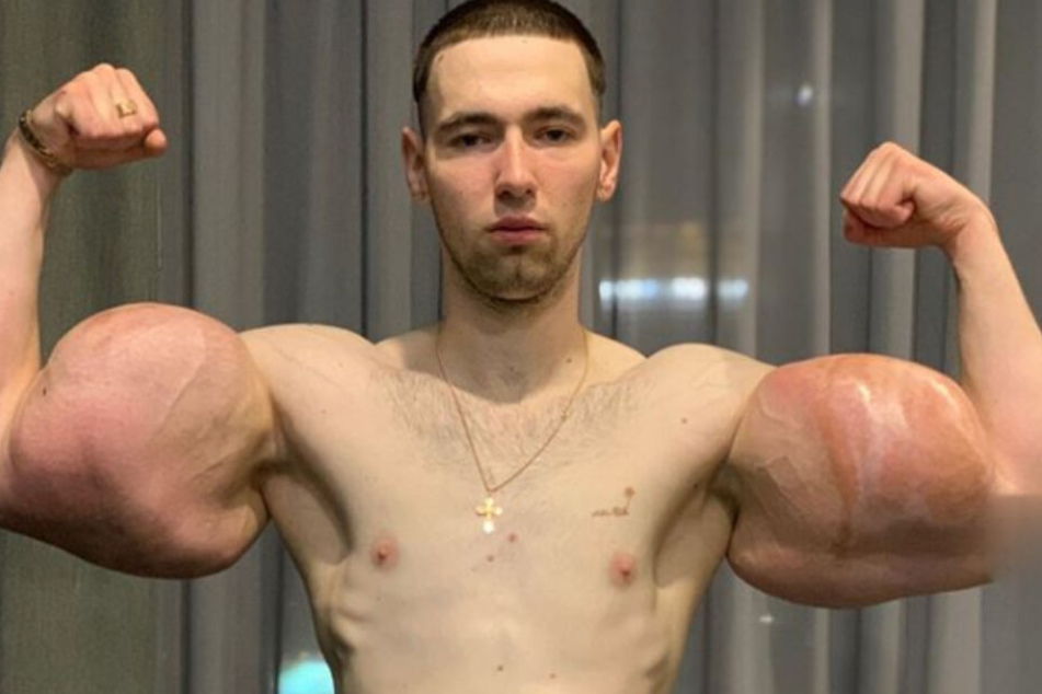 Die Arme des MMA-Kämpfers "Popeye" sind voller schädlicher Vaseline. Eine Amputation oder Schlimmeres drohten.
