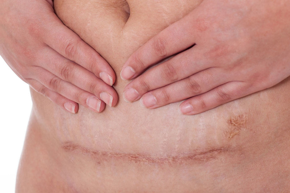 Wirtschaftlicher Schnitt: Musste diese Narbe sein?