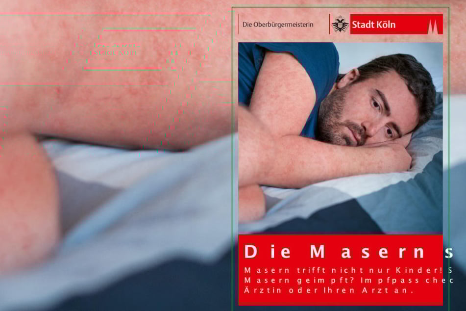 Die Stadt Köln wirbt jetzt mit Plakaten für eine Masern-Impfung.