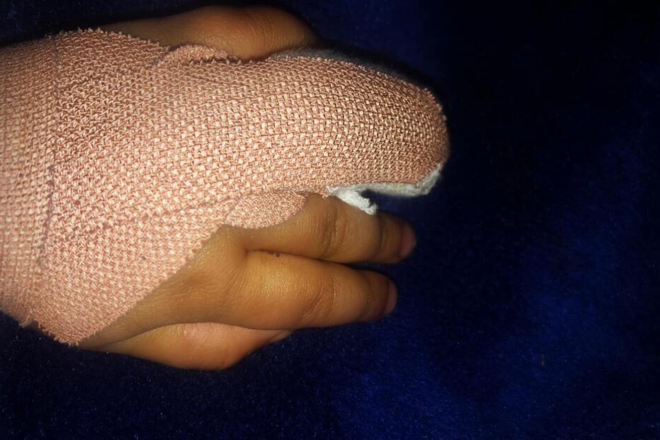 Der Finger konnte im Krankenhaus wieder angenäht werden.