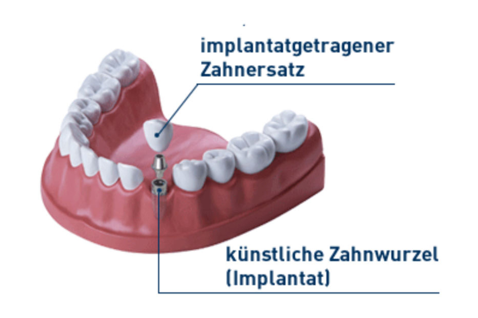 Unauffällig und bequem: Zahnimplantate sind nicht mehr unerreichbar.