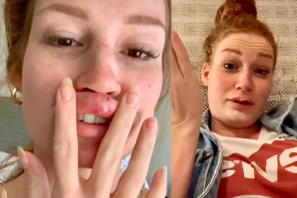 Am nächsten Tag sehen die Blessuren schon etwas weniger dramatisch aus. Und überhaupt: Jana Heinisch nimmt den Vorfall gelassen.