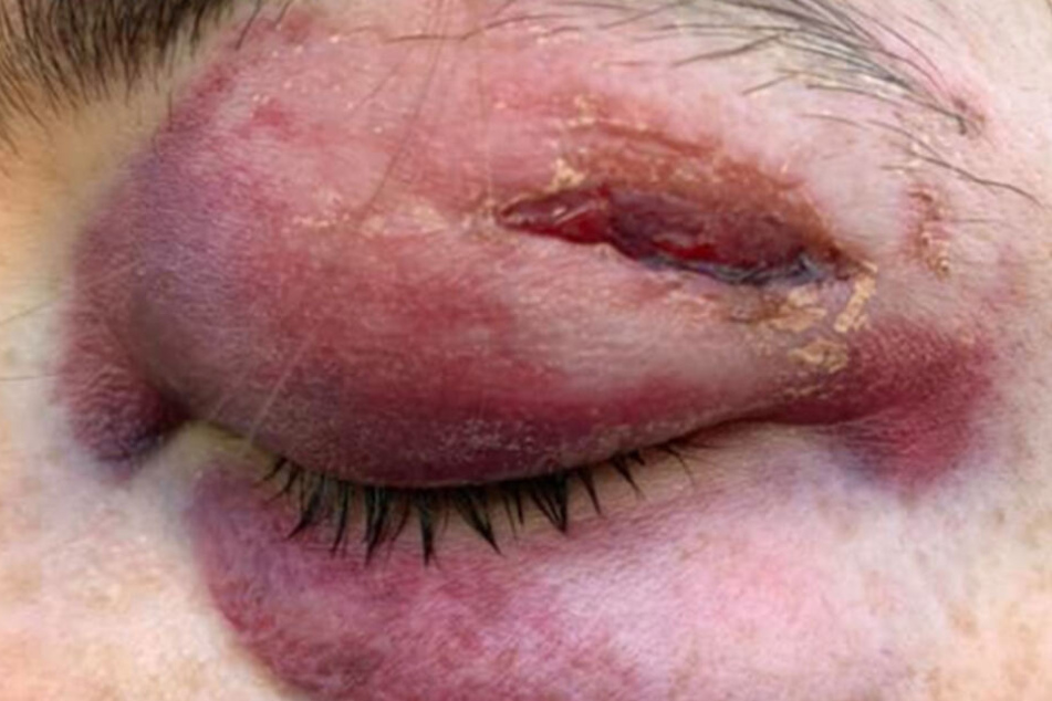 Gabrielle kann das Auge kaum öffnen.