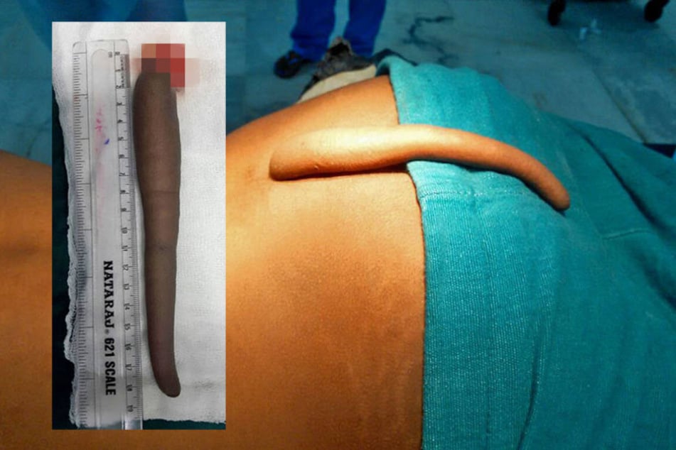 7 inch - also mehr als 17 Zentimeter - war das zusätzliche Körperteil lang.
