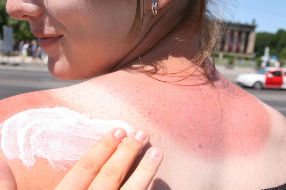 Ein Sonnenbrand kann äußerst schmerzhaft sein. (Symbolbild)