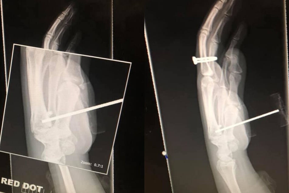 Beim Röntgen wurde klar: Der Metallstab hatte sich bis in den Knochen gebohrt.