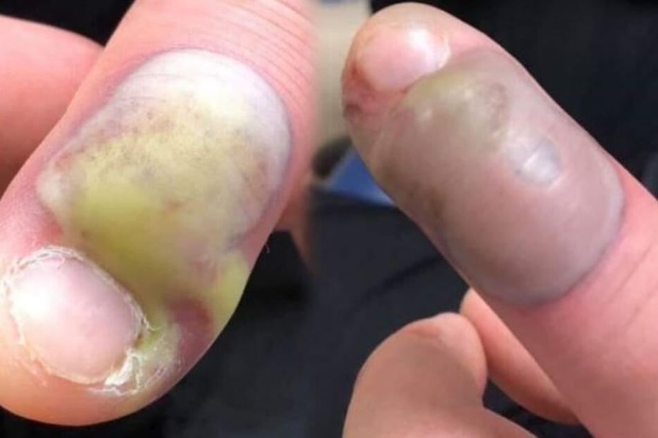 Frau warnt mit Horror-Fotos vor dem Fingernagel kauen