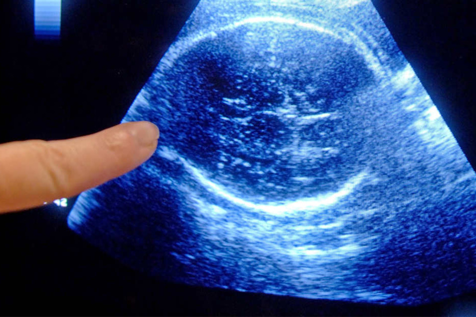 Es war eine "Molarenschwangerschaft"- dabei entwickelt sich zwar die Plazenta, aber nicht der Embryo.