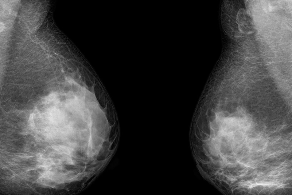 Ein Mammographie-Röntgenbild einer Brustkrebspatientin. Brustkrebs fordert in Deutschland jährlich 17.000 Todesfälle.