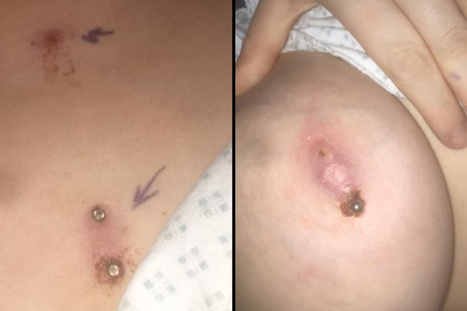 Auf den Bildern sieht man, dass zwei der Piercings unter ihre Haut gerutscht sind.