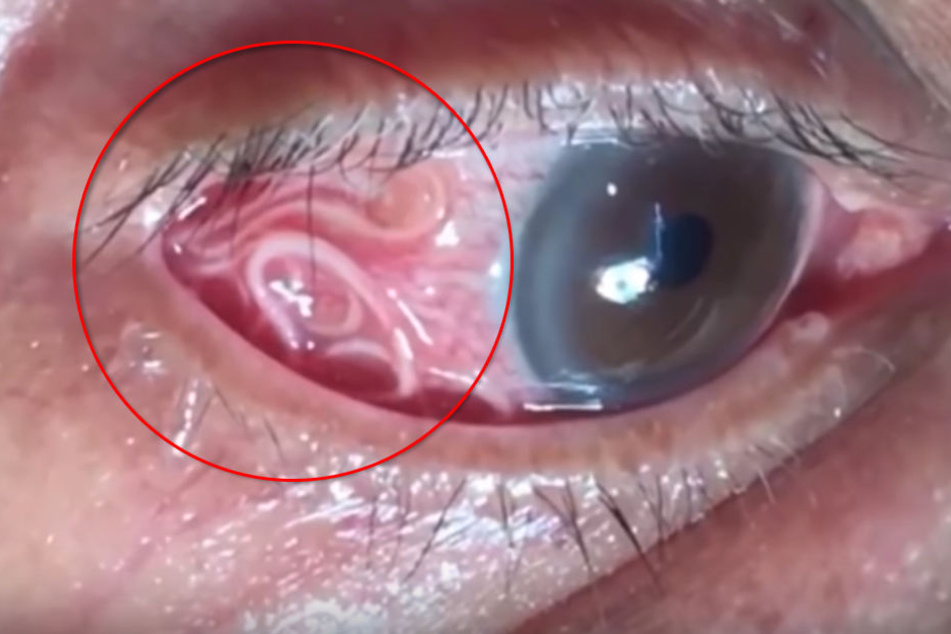 In Indien wurde ein 15 Zentimeter langer Wurm im Auge eines 60-jährigen Mannes entfernt.