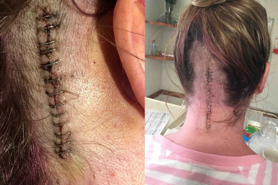 Riesige Nähte zieren seit den Operationen den Kopf der 40-Jährigen.