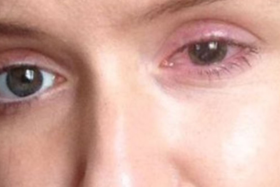 Meabh McHugh-Hill (23) wäre fast erblindet. Sie riss sich ein Stück Hornhaut vom Auge.