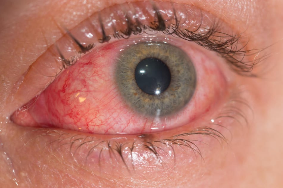 So schlimm gerötete Augen sollte sich unbedingt ein Arzt anschauen.