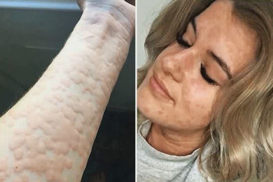 Arianna Kent leidet unter kalter Urtikaria. Wenn ihr Körper in Kontakt mit Kälte kommt, reagiert ihre Haut mir roten, juckenden Flecken.