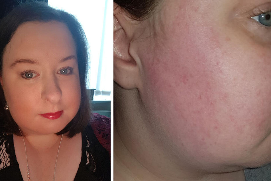 Stacey Parker (31) leidet an allergischen Reaktionen und Schwellungen.
