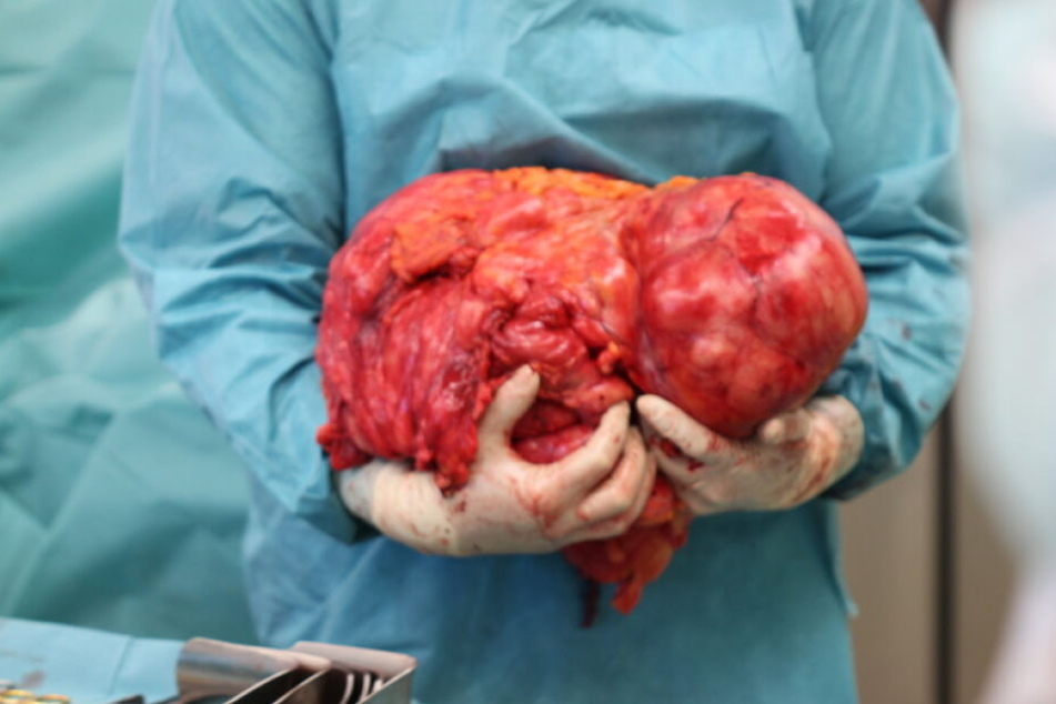 Diesen Tumor schnitten die Chirurgen aus dem Bauch der Frau.