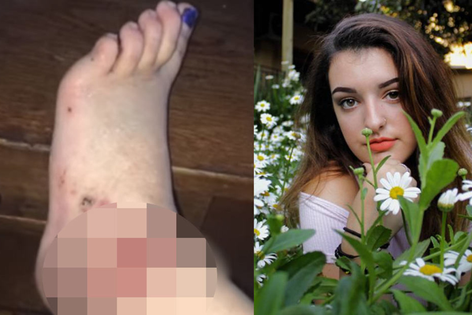 Die 19-Jährige verlor fast ihren Fuß!