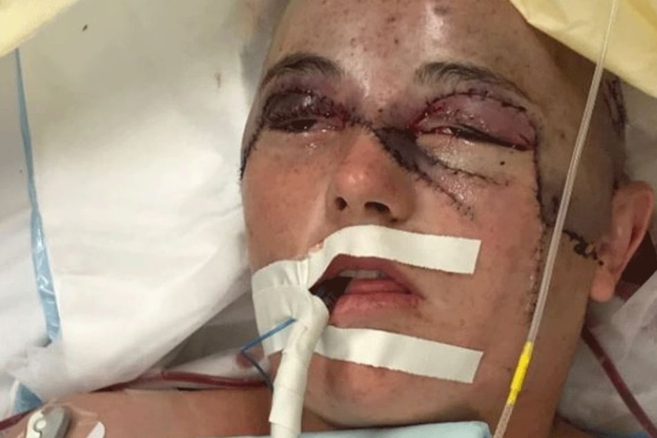 Vom Unfall schrecklich gezeichnet: Casey Barnes
