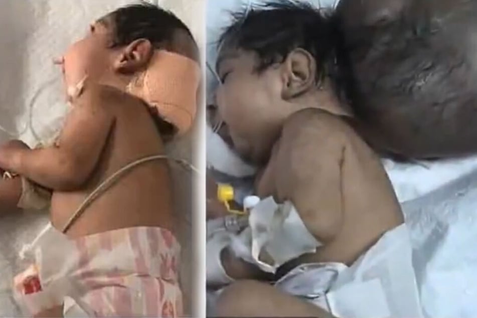 Das Baby wurde mit einem zweiten Kopf geboren, der später in einer Operation entfernt werden konnte.