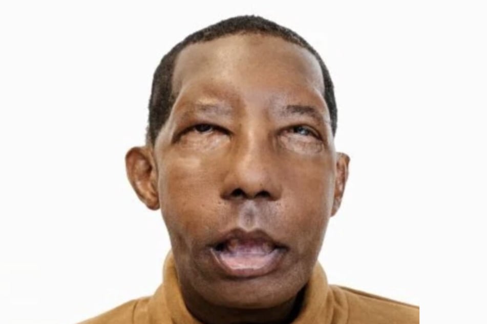 Nach der Transplantation: Nase, Ohren und Lippen sind wieder intakt.