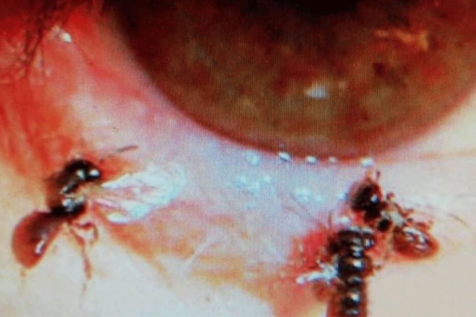 Drei der vier Schmalbienen, die der Arzt im Auge entdeckte.