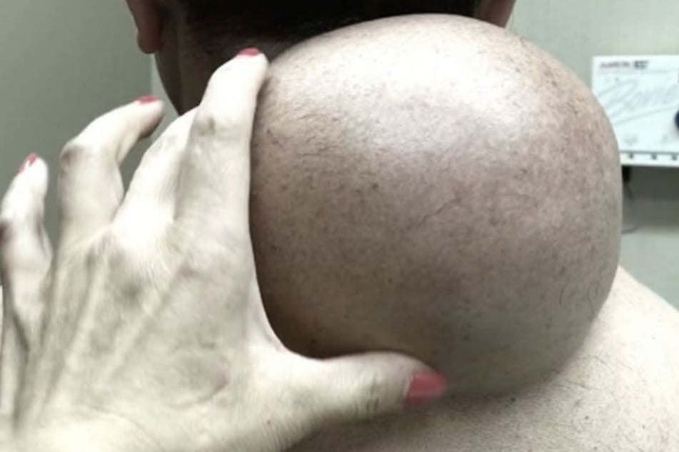 Dr. Pimple Popper bei der Arbeit: Dieser Pickel hat es in sich.