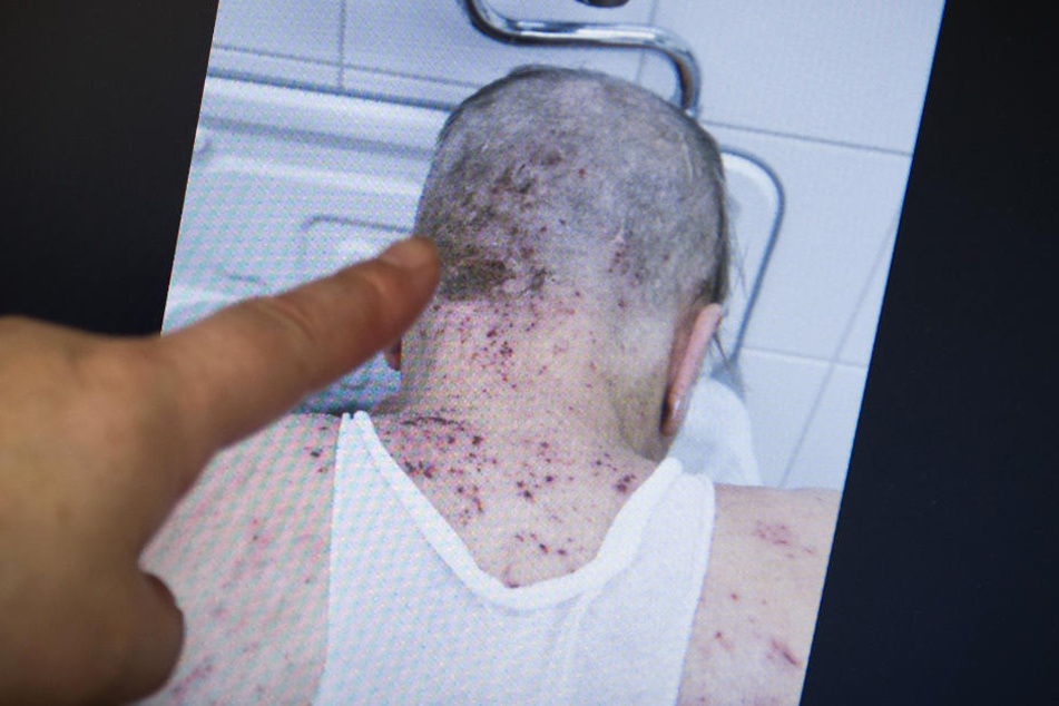 Das Archivbild zeigt einen von Krätze befallenen Mann.