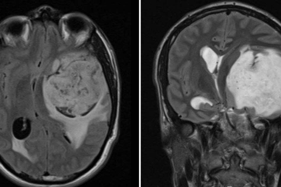 Im Mai fand man bei dem Australier einen riesigen Tumor im Kopf.