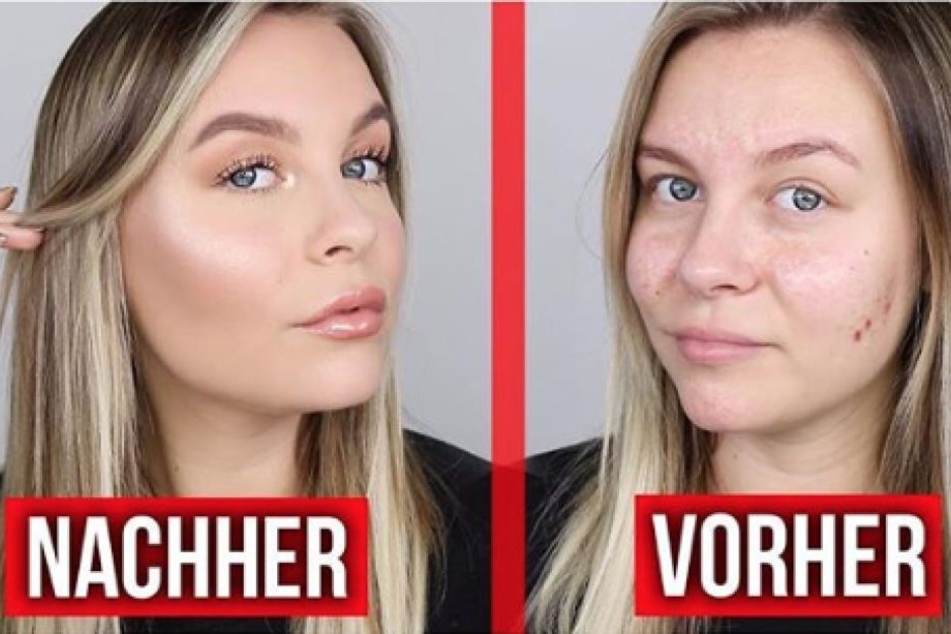 Dagi Bee (24) steht zu ihren Hautunreinheiten und spricht offen darüber.