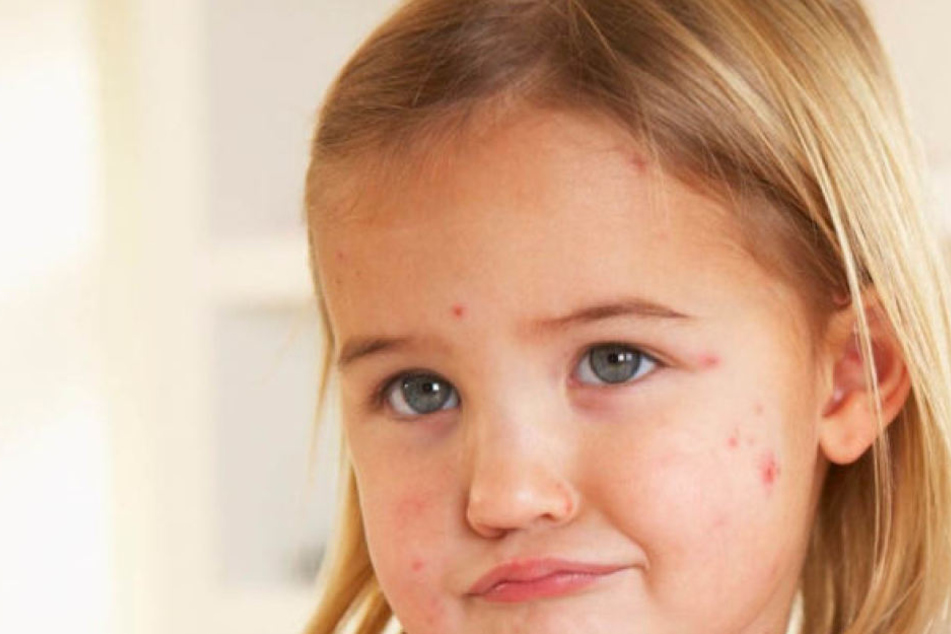 Die als Kinderkrankheit bekannten Masern sind zurück: In Leipzig steckte sich eine Jugendliche mit der hochansteckenden Krankheit an. (Symbolbild)