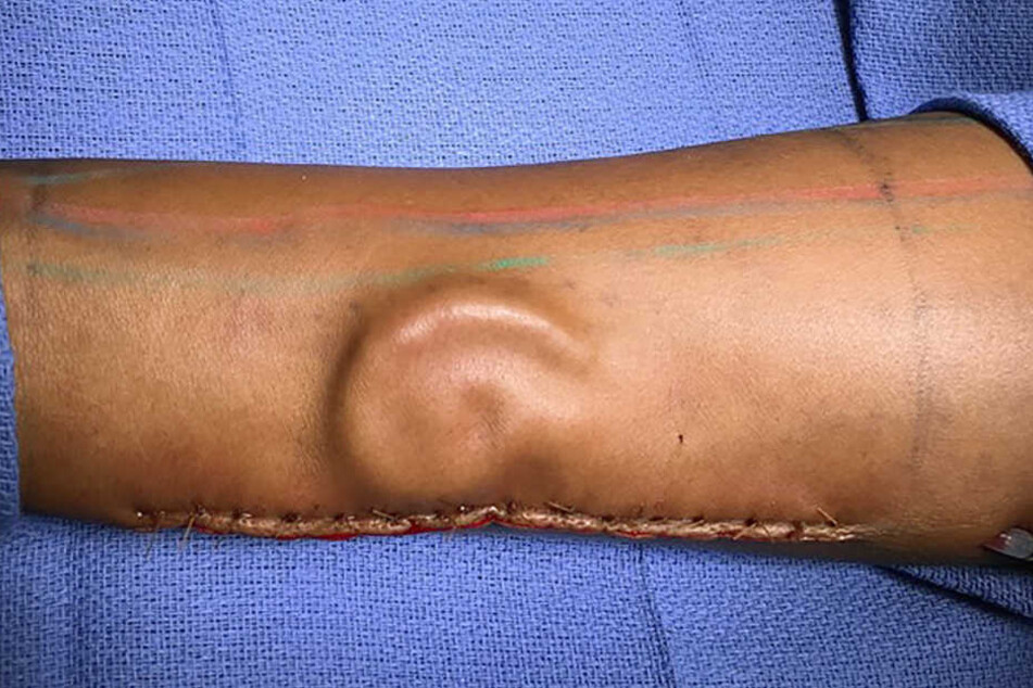 Dieses Ohr wächst im Unterarm einer Patientin.