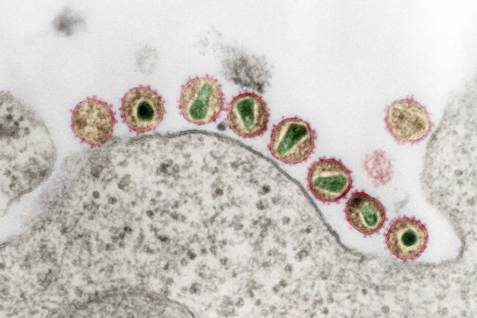 Ein Mann aus Düsseldorf, der sich mit HIV infiziert hatte, gilt einer Stammzelltransplantation als geheilt.
