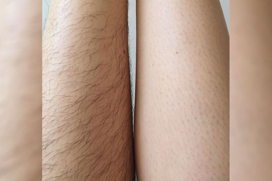 Immer mehr Frauen zeigen auf Instagram ihre Beinbehaarung.