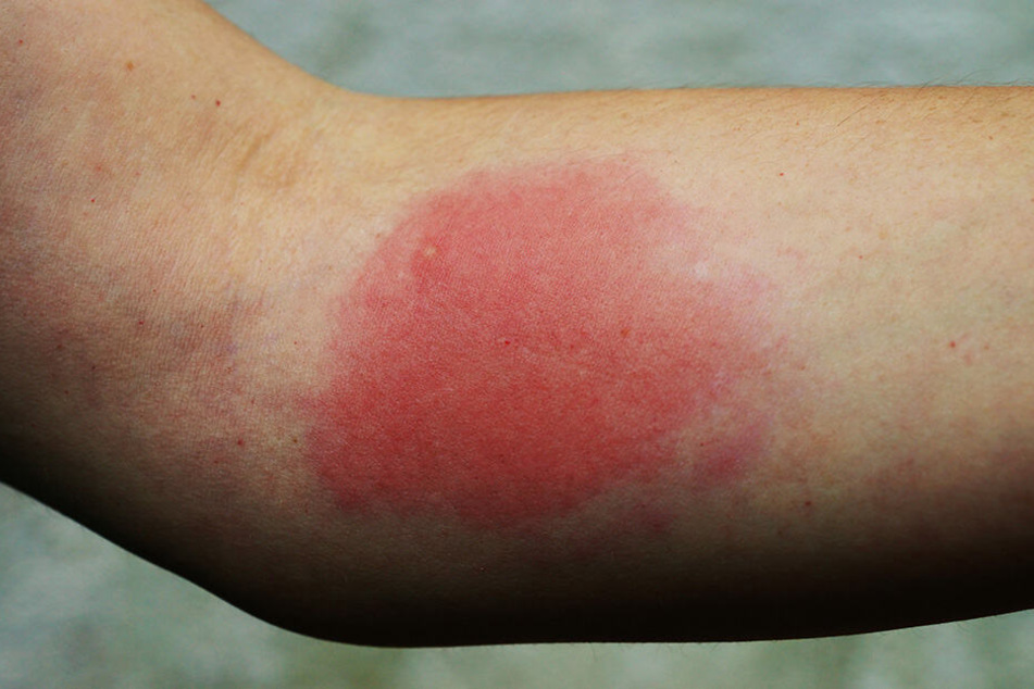 Carls Hausarzt tat alle Warnzeichen als harmlos ab. (Symbolbild)