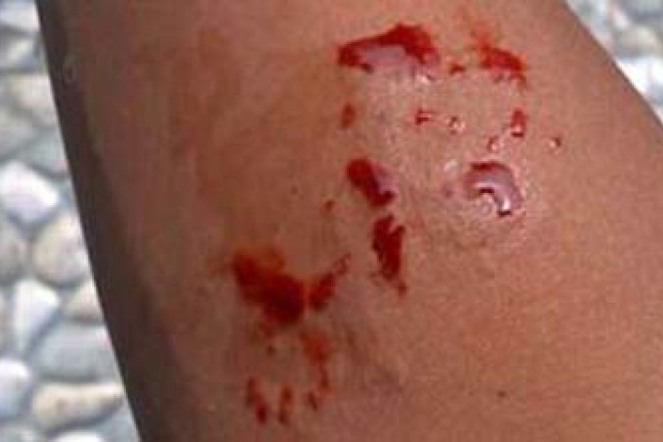 Verzweifelt schickte der Junge Fotos seines Arms im Netz. Er brauchte dringend Hilfe. Doch die kam viel zu spät.