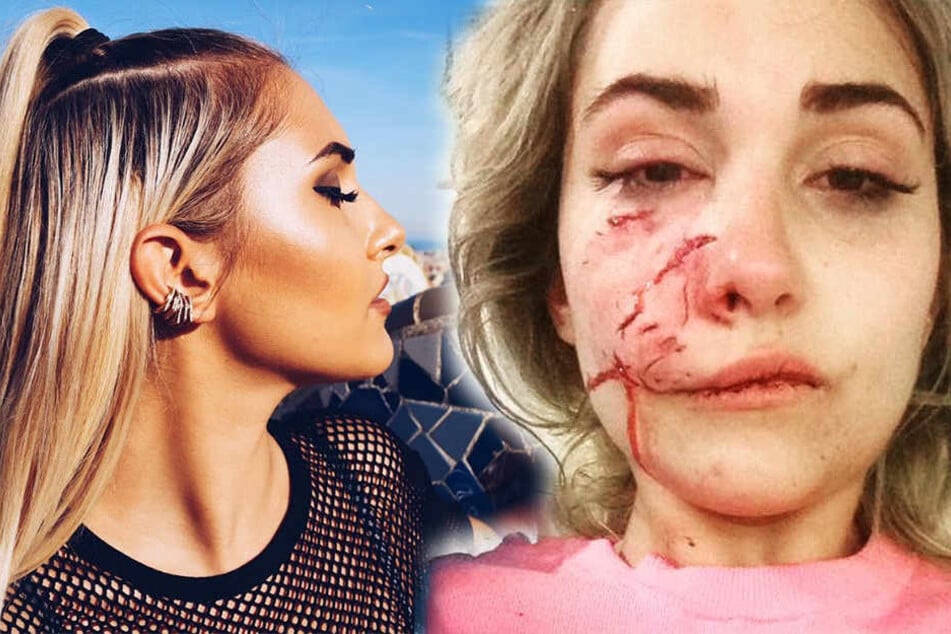 Suzel Mackintosh vor und nach der Beißattacke: Das Model erlitt auf der rechten Gesichtshälfte tiefe Wunden und operiert werden.