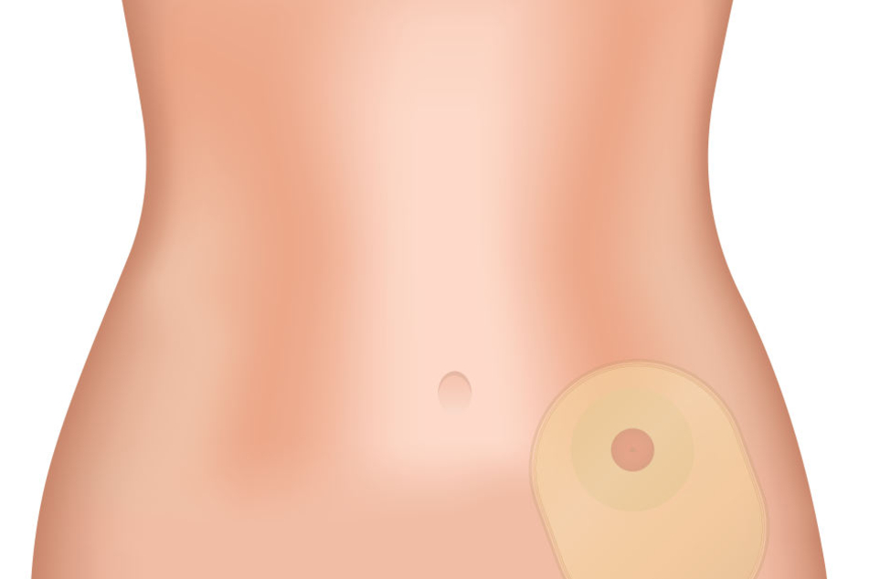 Das Symbolbild zeigt, wo der Ostomie-Beutel, der den Kot des Patienten auffängt, angebracht wird.