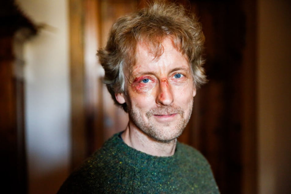 Stadtrat Torsten Schulze (49, Grüne) kam mit dieser Verletzung in den Stadtrat.