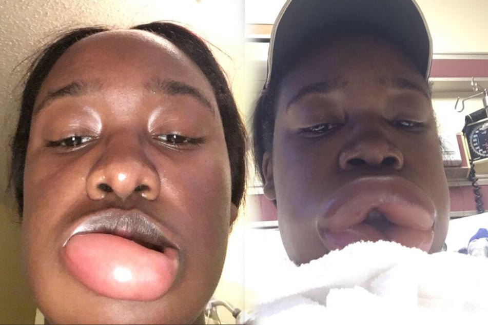 Die Lippe der 18-Jährigen schwoll gigantisch an.