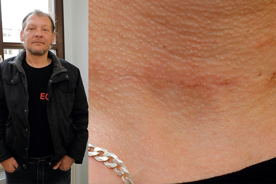 Thomas Hempel (47) überlegte die Attacke nur knapp. Die Narben sind immer noch zu sehen.