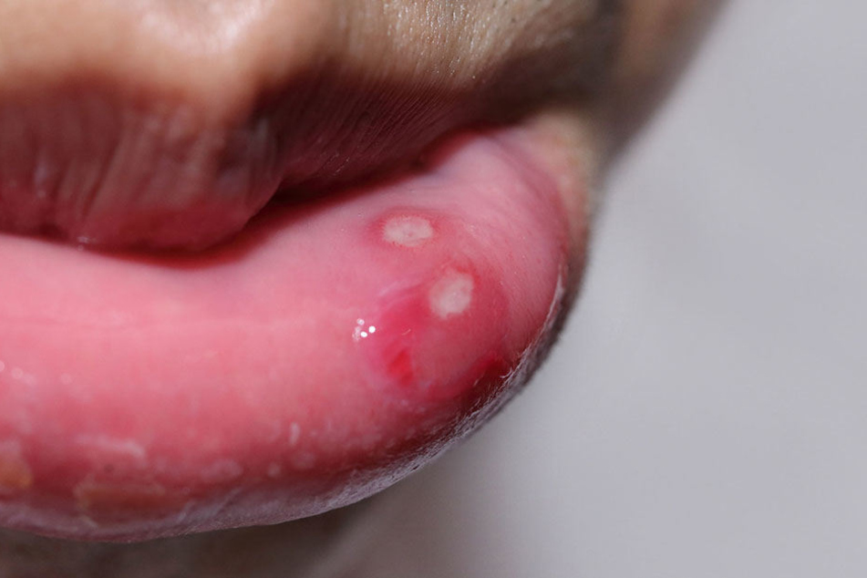Mit Herpes ist nicht zu spaßen, so gar nicht während der Schwangerschaft.