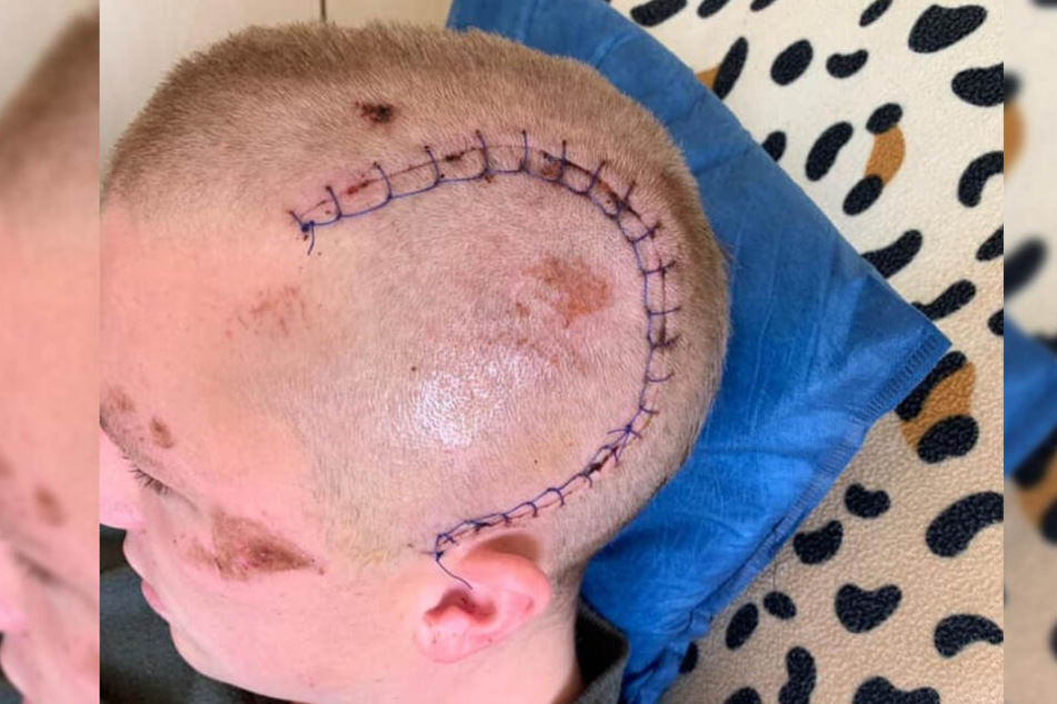 Die Wunde des Opfers musste mit zahlreichen Stichen genäht werden.