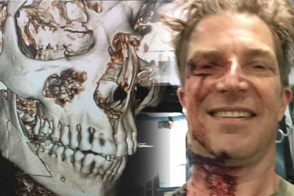Nachdem der 48-Jährige von einem Van angefahren wurde, musste ihm eine Titanplatte eingesetzt werden.