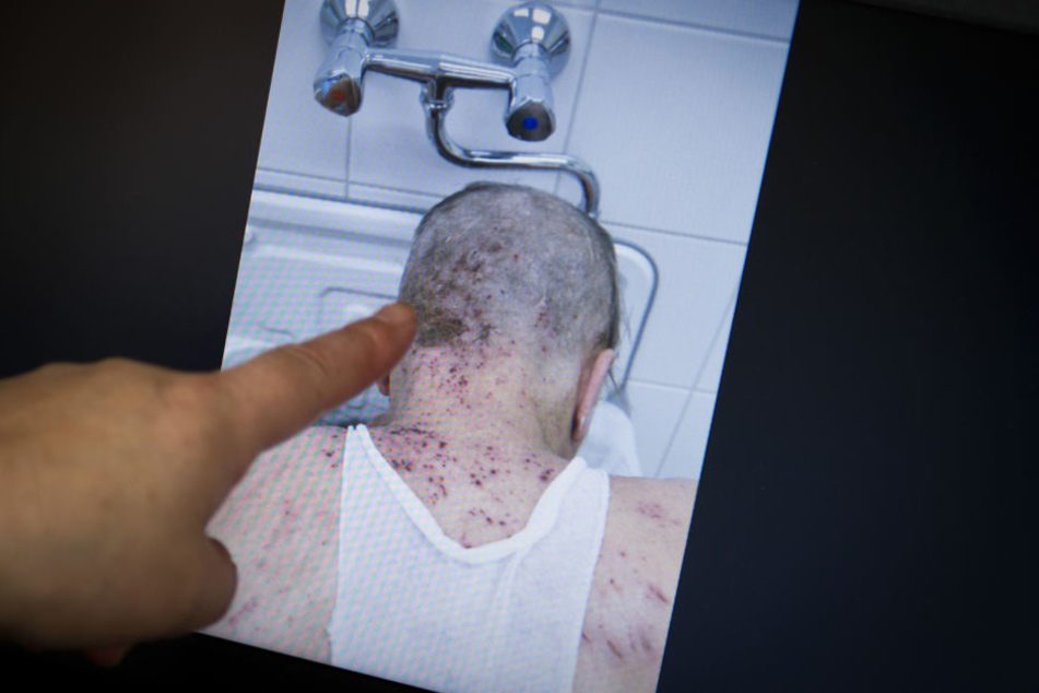 Auf dem Vormarsch: Das Foto zeigt einen von Krätze befallenen Patienten.