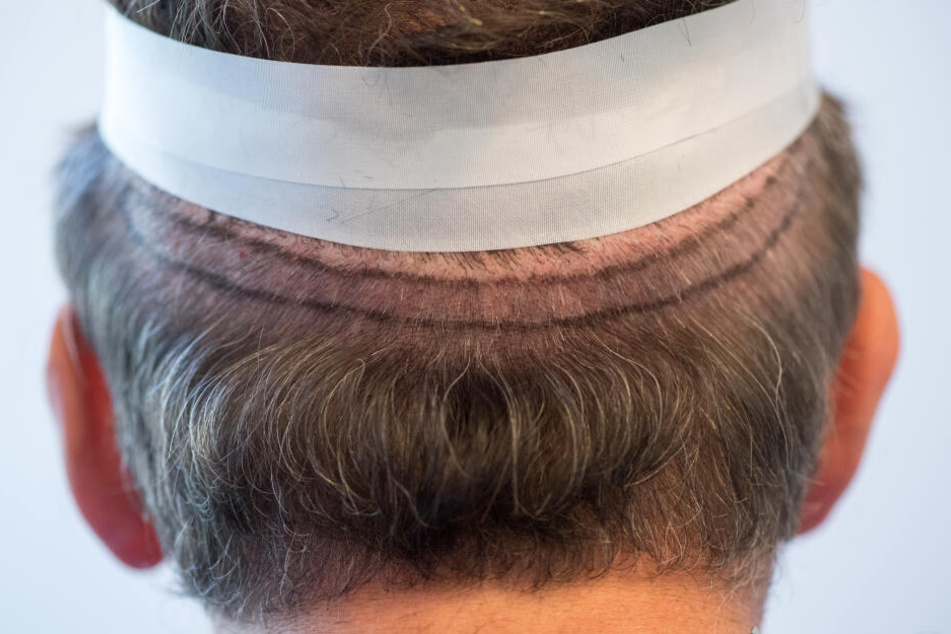 Bei der Streifenentnahme wird da, wo noch genügend Haare wachsen, ein schmaler Haarstreifen entnommen, um daraus die Haarwurzeln zu entnehmen. (Archivbild)